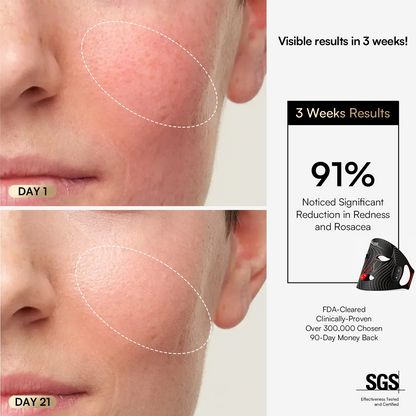 SORA Wireless Red Light Therapy Mask